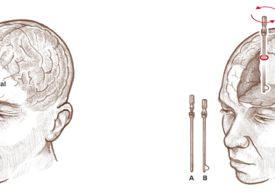 lobotomie  standard.